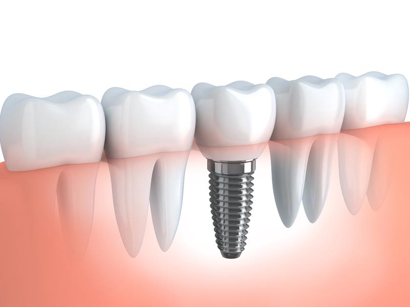 Dental Implants  Wilmington, DE 